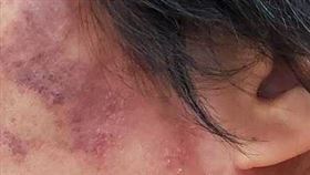 皮蛇示意圖。（圖／書田診所提供）