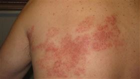 皮膚長痘痘，前胸蔓延到後背，「皮蛇」帶狀疱疹 (示意圖／林新醫院提供)