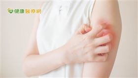 異位性皮膚炎病友協會表示，異位性皮膚炎對患者身心影響大，呼籲病友應尋求專業醫師協助，並積極接受治療。（圖片來源： shutterstock）