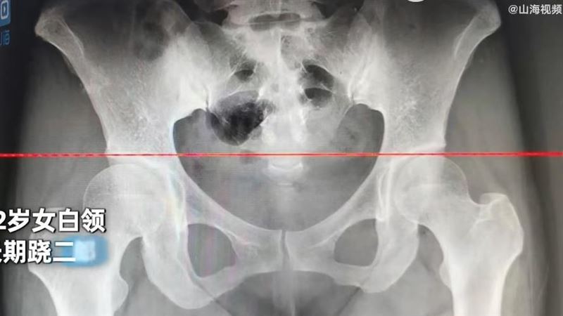 愛蹺二郎腿　女OL慘變「長短腿」