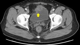 膀胱癌(慈濟醫院提供)
