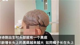 ▲女童出生頭頂長黑痣。（圖／翻攝自微博）