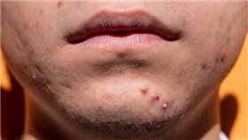 青春痘,皮膚,痘痘,內分泌失調,熬夜,pixabay