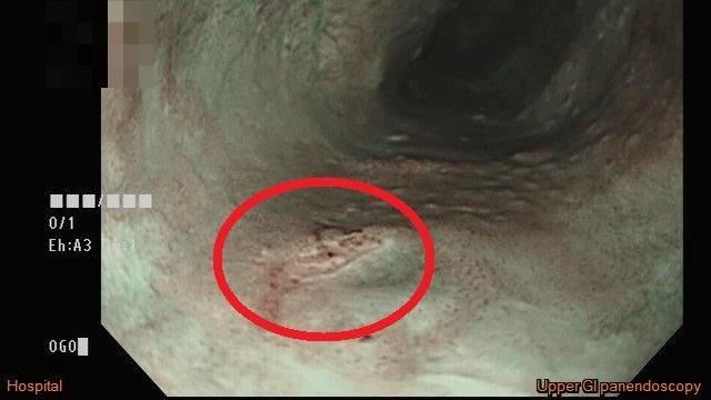 喉嚨卡卡異物感　竟是「準惡性腫瘤」