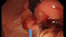 食道癌,腫瘤,胃食道逆流,（圖／新竹臺大分院提供）