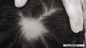 圓禿（讀者提供）