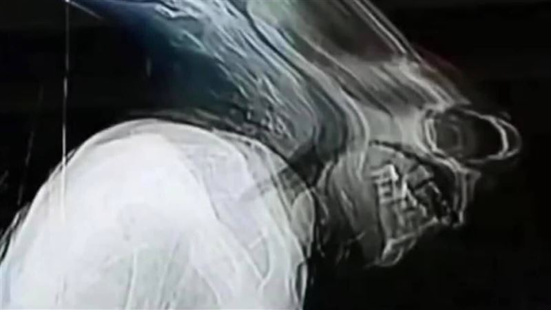 她照X光打噴嚏…照片網笑瘋：異形欸