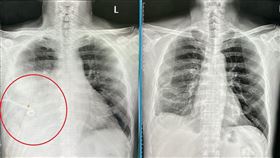 肋膜炎治療前後對比。（圖／烏日林新醫院提供）