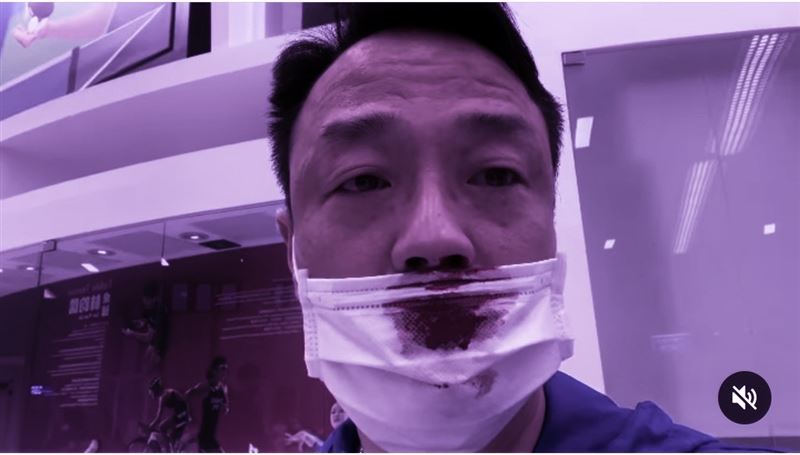 港星入境爆意外　滿臉鮮血PCR陽性