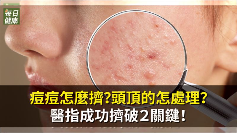 痘痘別亂擠！醫指成功擠破2關鍵
