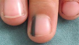 指甲有黑線=罹癌？皮膚醫5症狀解密(圖/翻攝畫面)