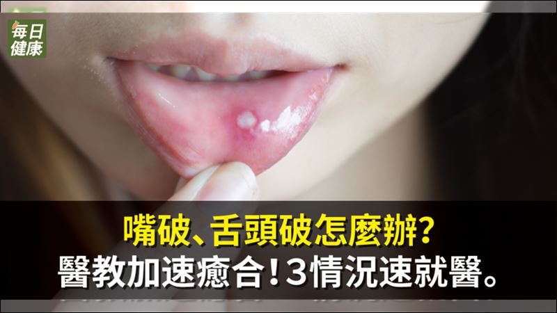 嘴破、舌破未必是小事！3情況速就醫