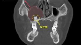 異生齒,鼻竇炎,膿,過敏（圖／中醫大新竹附醫提供）