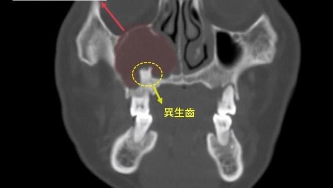 鼻竇炎好不了還流膿　竟是鼻腔長牙齒