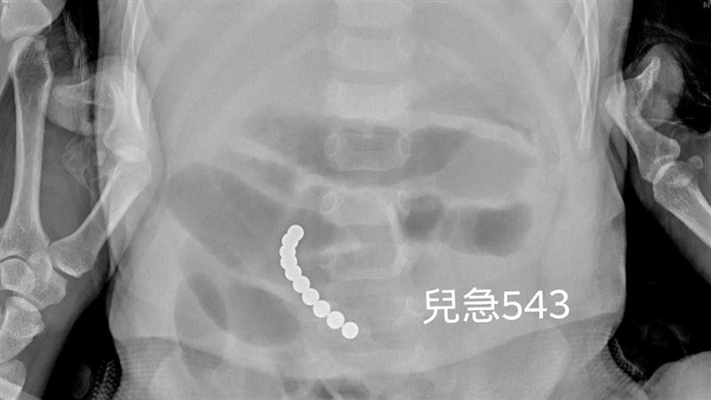 2歲童狂吐！照X光嚇：10恐怖白點