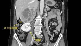 影像檢查中，某些角度上嗜鉻細胞瘤甚至已比腎臟還要大。（圖／台北慈院提供）