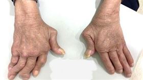 類風濕性關節炎示意圖。（圖／風濕病基金會台灣抗風濕病聯盟提供）