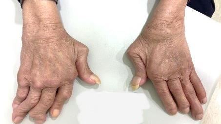 「這種病」讓她手指變形連門都打不開