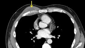 胸壁膿瘍。（圖／台北慈濟醫院提供）
