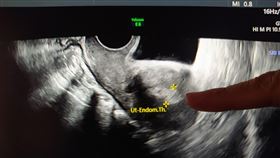 個案陰道超音波顯示子宮內膜超過1公分厚。（圖／台中慈濟醫院提供）