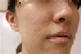 臉紅青春痘好不了！醫：毛細孔都有蟲（圖／翻攝畫面）
 
