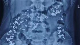 男孩誤吞訂書針。（圖／翻攝自天眼新聞 微博）