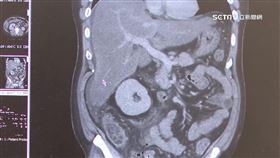 36歲壯男生飲鱉血狂拉肚!醫:猛爆性肝炎險斃命