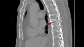 僵直性脊椎炎/台中醫院急診醫學科醫師林逸婷(院方提供)