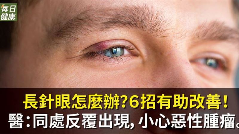 長針眼怎麼辦？　這６招有助改善！