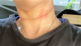 前線醫護長時間穿著防護衣，脖子被壓出勒痕。（圖／陳姓網友授權提供）