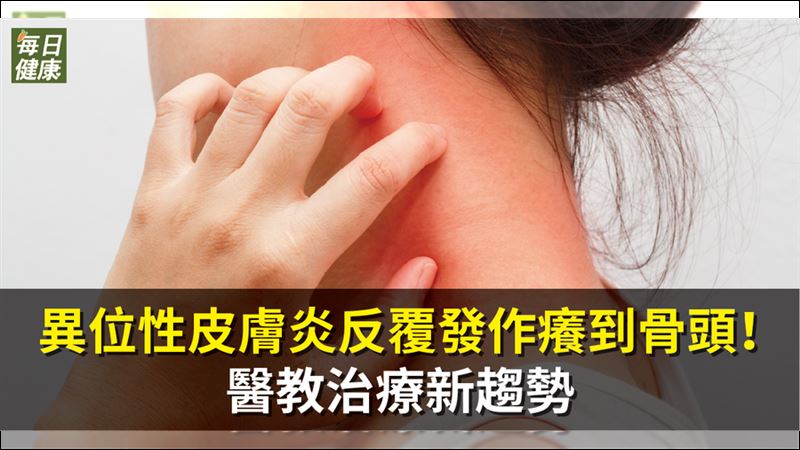 異位性皮膚炎反覆　9成病友深受其擾