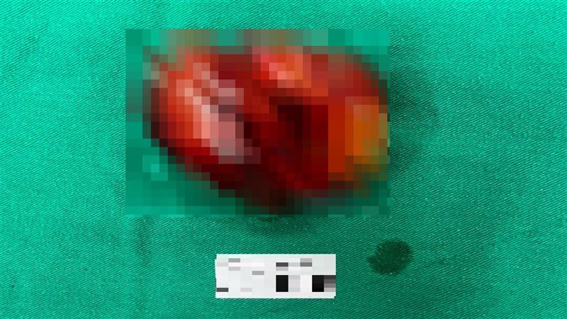 腰痛竟是腎臟長腫瘤　良性也可能致命