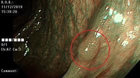 大腸息肉(陳弋)