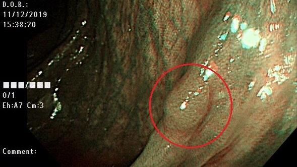 一圖看息肉變大腸癌　秒懂5危險因子