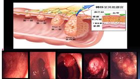 大腸癌,安南醫院,息肉,黃文威
圖／安南醫院提供