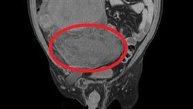 劉先生腹痛就醫，檢查發現一近30公分腫瘤(紅圈處)。（圖／大千綜合醫院提供）