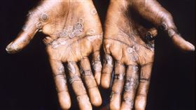 猴痘（monkeypox） 路透社