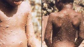 ▲「猴痘」（monkeypox）（圖／翻攝自美國CDC官網）
https://www.cdc.gov/poxvirus/monkeypox/index.html