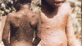 M痘、猴痘（monkeypox）（圖／翻攝自美國CDC官網） https://www.cdc.gov/poxvirus/monkeypox/index.html