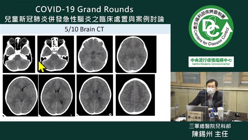 4歲女童染疫亡　猛爆性腦炎反覆痙攣