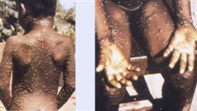▲「猴痘」（monkeypox）（圖／翻攝自美國CDC官網）
https://www.cdc.gov/poxvirus/monkeypox/index.html