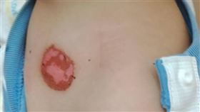 有家長給孩子使用配戴式消毒產品，結果竟造成孩子皮膚化學性灼傷。（圖／林唐宇醫師提供）