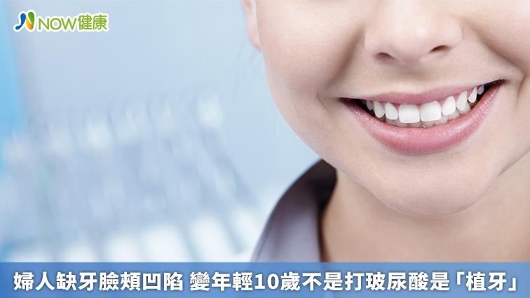 缺牙臉頰凹陷　不打玻尿酸靠植牙恢復