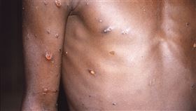 世衛：若迅速採取行動　猴痘疫情可控制 （圖／美聯社／達志影像）