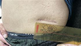 謝博欽表示，林先生患有脊椎椎間盤退化性疾病，由於術後還想繼續做工，與患者討論後決定採用微創的方式，在腰側開一節融合術，傷口小僅有5公分。（圖／烏日林新醫院提供）