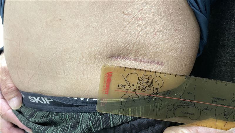 師傅挖到骨頭壞掉？不吃藥找醫做這事