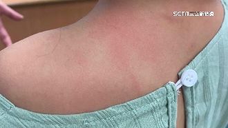 獨／嬤控醫太粗暴！打疫苗抓傷孫女