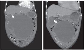 ▲電腦斷層圖顯示，治療初期患者腸壁沾黏在鈣化腹膜上（左），
三個月後顯示小腸擴張症狀有所改善（右）。（圖／北榮提供）
