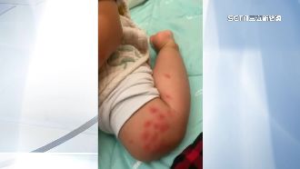 兒美館小黑蚊肆虐　童半小時被叮百包