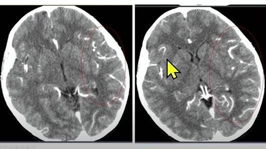 驚！7歲腦炎童大喊：我們都要死掉了